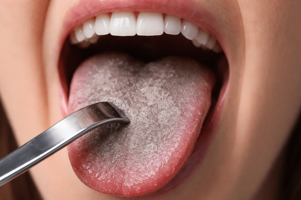 Серый налет на языке: основные причины, симптомы и практические рекомендации по диагностике и лечению у взрослых.
