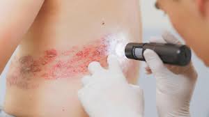 Вакцинация от опоясывающего лишая может значительно снизить риск развития деменции. Исследования показывают, что прививка уменьшает вероятность болезни через несколько лет