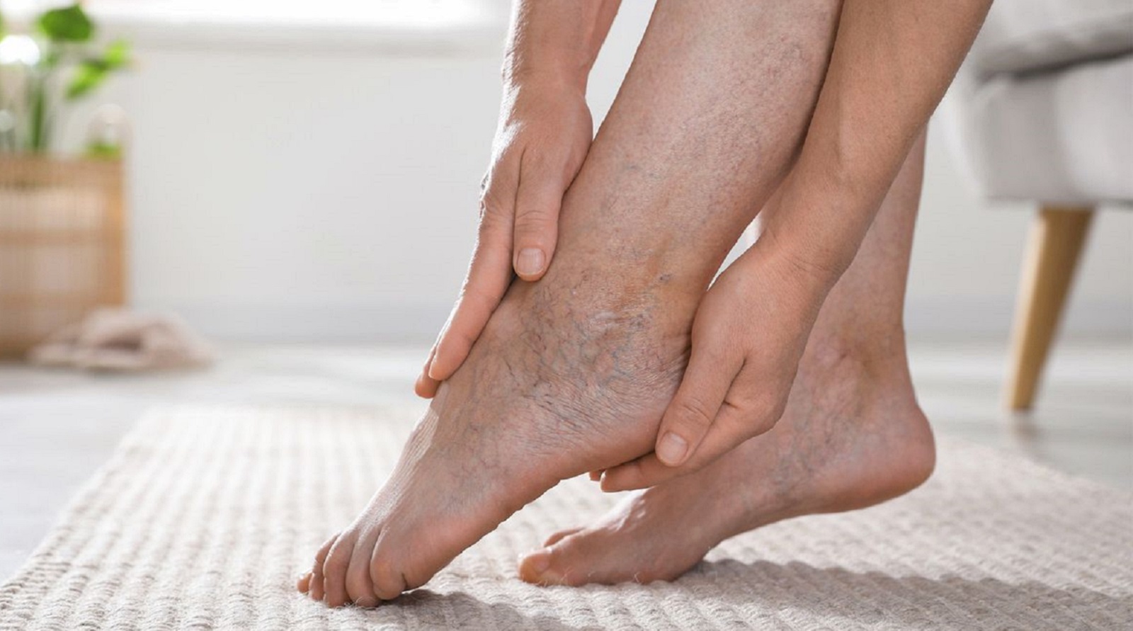 Варикозное расширение вен: причины, симптомы, лечение и домашние способы облегчить состояние. Что нельзя делать при варикозе и как защитить сосуды.